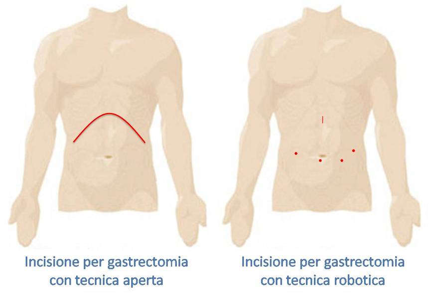 chirurgia gastrica chirurgia gastrica