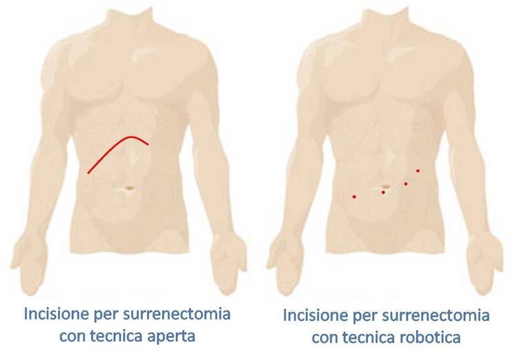 chirurgia del surrene